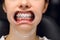 A young woman with metal braces is being examined by an orthodontist. Correction of the bite of teeth in the dental