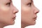 Young woman before and after rhinoplasty and nose hump, shape correction on white background, cosmetology and aesthetic surgery