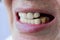Zirconia Crowns of Front Teeth