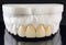 Zirconia crowns with full porcelain in the plaster model for dental treatment. Restoration of teeth on the upper jaw. Production