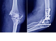 膜肘骨折内上髁肱骨及内固定支柱库存图片 图片包括有经纪 医疗 诊断 医院 考试 健康