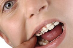 A Young Girl With Braces Stock Images