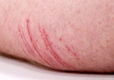 skin abrasion stock images download 509 photos