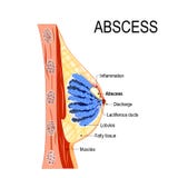 Abscess. Cross-section of the mammary gland with inflammation vector illustration Abscess. Cross-section of the mammary gland with inflammation vector illustration