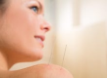 Agulha da acupunctura que pricking no ombro da mulher Fotos de Stock Agulha da acupunctura que pricking no ombro da mulher Fotos de Stock
