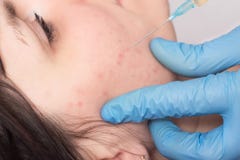 Aknebehandling på framsidan som plasma-lyfter, plasmaterapi, doktorn, gör injektionen av blodplasma till den tålmodiga närbilden arkivfoto Aknebehandling på framsidan som plasma-lyfter, plasmaterapi, doktorn, gör injektionen av blodplasma till den tålmodiga närbilden arkivfoto