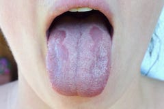 Устный кандидоз или устные albicans кандиды trush, инфекция дрожжей на человеческом конце языка вверх, стоковое изображение rf Устный кандидоз или устные albicans кандиды trush, инфекция дрожжей на человеческом конце языка вверх, стоковое изображение rf