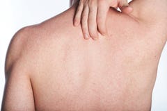 Alergia na plecy mężczyzna zdjęcie royalty free Alergia na plecy mężczyzna zdjęcie royalty free