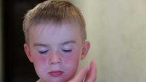 Allergie Au Soleil Sur Le Visage Du Bebe Taches Rouges Sous Les Yeux De L Enfant La Mere A Touche Son Visage L Enfant Est Triste Clips Videos Video Du Gosse Detail Allergie Au Soleil Sur Le Visage Du Bebe Taches Rouges Sous Les Yeux De L Enfant La Mere A Touche Son Visage L Enfant Est Triste Clips Videos Video Du Gosse Detail