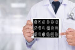 Alzheimers choroby pojęcie, Móżdżkowe degeneracyjne choroby Parkin zdjęcia royalty free Alzheimers choroby pojęcie, Móżdżkowe degeneracyjne choroby Parkin zdjęcia royalty free