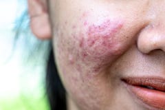 Ambiti di provenienza della pelle delle lesioni causati da acne sul fronte fotografia stock Ambiti di provenienza della pelle delle lesioni causati da acne sul fronte fotografia stock
