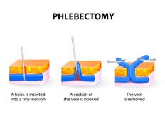 Ambulante Phlebectomy-Behandeling vector illustratie Ambulante Phlebectomy-Behandeling vector illustratie