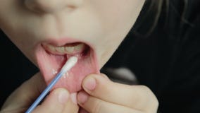 Amphotoid stomatitis Wrzód na dziąsłach Grzybowy Candida zbiory wideo Amphotoid stomatitis Wrzód na dziąsłach Grzybowy Candida zbiory wideo