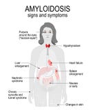 Amyloidosis. Signs and symptoms. Stock Photo Amyloidosis. Signs and symptoms. Stock Photo