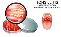 angine streptocoque l'agent causatif de l'infection s bactérien illustration de vecteur angine streptocoque l'agent causatif de l'infection s bactérien illustration de vecteur