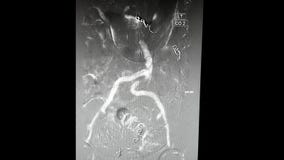 Angiography of aorta and both iliac arteries