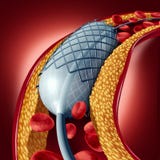 Angioplastie et concept de Stent illustration stock Angioplastie et concept de Stent illustration stock