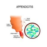 Appendicitis. Human appendix and bacterial growth inside the app Stock Photography Appendicitis. Human appendix and bacterial growth inside the app Stock Photography