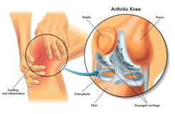 Arthritic knee