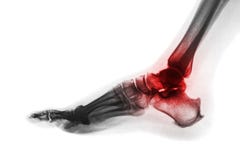 Arthritis of ankle . X-ray of foot . Lateral view . Invert color style . Gout or Rheumatoid concept stock photos Arthritis of ankle . X-ray of foot . Lateral view . Invert color style . Gout or Rheumatoid concept stock photos