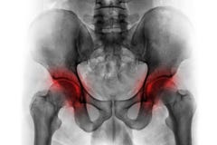 Artritis beide heup Filmröntgenstraal van menselijk bekken stock afbeeldingen Artritis beide heup Filmröntgenstraal van menselijk bekken stock afbeeldingen