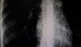 ASD Stent royalty-vrije stock afbeelding ASD Stent royalty-vrije stock afbeelding
