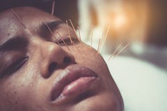 Asian women 40 years old acupuncture acupuncture on face royalty free stock photo Asian women 40 years old acupuncture acupuncture on face royalty free stock photo