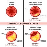 Atherosclerosestadien Cholesterinplaketten stock abbildung Atherosclerosestadien Cholesterinplaketten stock abbildung