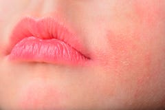 Atopic Dermatitis Stock Photography Atopic Dermatitis Stock Photography