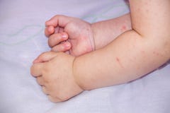 Baby met dermatitisprobleem van uitbarsting Allergie die aan voedselallergieën lijden Close-up atopic symptoom op huidwangen stock afbeeldingen Baby met dermatitisprobleem van uitbarsting Allergie die aan voedselallergieën lijden Close-up atopic symptoom op huidwangen stock afbeeldingen