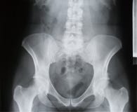 Backbone, pelvis, socket of hip joint, thigh bone x-ray, osteoporosis