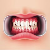 Bagues dentaires de vecteur, système oral 3d de brakets illustration de vecteur Bagues dentaires de vecteur, système oral 3d de brakets illustration de vecteur