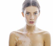 Beautiful Young Brunette Woman With Vitiligo Stock Photography Beautiful Young Brunette Woman With Vitiligo Stock Photography