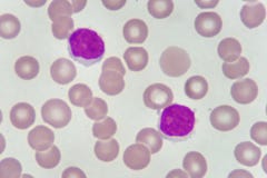 Blood smear of chronic lymphocytic leukemia Stock Photo Blood smear of chronic lymphocytic leukemia Stock Photo