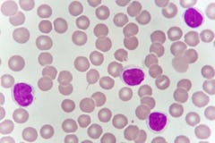 Blood smear of chronic lymphocytic leukemia Royalty Free Stock Image Blood smear of chronic lymphocytic leukemia Royalty Free Stock Image