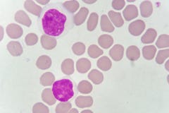 Blood smear of chronic lymphocytic leukemia Stock Images Blood smear of chronic lymphocytic leukemia Stock Images