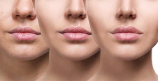 Bordos da jovem mulher antes e depois do aumento imagens de stock Bordos da jovem mulher antes e depois do aumento imagens de stock