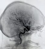 Brain angiography, arteriography