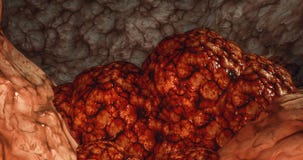 Brest för cancer för kolon för lymfkörtelcancer för carcinoma för cysta för tumör för cancer för begrepp för Oncology för cancerc vektor illustrationer Brest för cancer för kolon för lymfkörtelcancer för carcinoma för cysta för tumör för cancer för begrepp för Oncology för cancerc vektor illustrationer