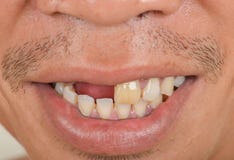 Broken teeth Damaging and ugly stock photo Broken teeth Damaging and ugly stock photo