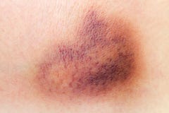 Bruise on skin royalty free stock photography Bruise on skin royalty free stock photography