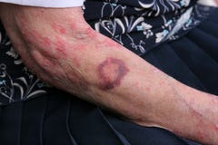Bruising and Sceriosis stock photos Bruising and Sceriosis stock photos