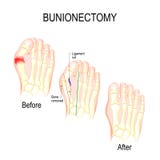 Bunionectomy χειρουργική επέμβαση για να διορθώσει τις παθολογίες του ποδιού ελεύθερη απεικόνιση δικαιώματος Bunionectomy χειρουργική επέμβαση για να διορθώσει τις παθολογίες του ποδιού ελεύθερη απεικόνιση δικαιώματος