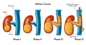 Cancro del rene Cancro del rene