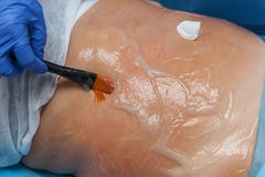 Carboxytherapy på kroppen arkivbilder Carboxytherapy på kroppen arkivbilder