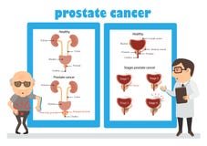 CARCINOMA DELLA PROSTATA royalty illustrazione gratis CARCINOMA DELLA PROSTATA royalty illustrazione gratis
