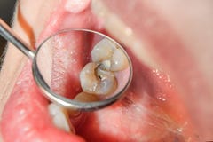 Carie dental Relleno de materi compuesto dental del photopolymer imágenes de archivo libres de regalías Carie dental Relleno de materi compuesto dental del photopolymer imágenes de archivo libres de regalías