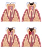Caries stages
