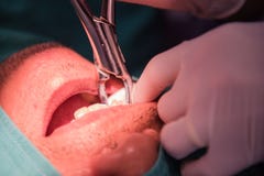 Caries tooth extraction by the dentist. Dentistry in hospital. Royalty Free Stock Image Caries tooth extraction by the dentist. Dentistry in hospital. Royalty Free Stock Image
