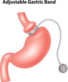 Cartoon illustration of Adjustable Gastric Band royalty free illustration Cartoon illustration of Adjustable Gastric Band royalty free illustration